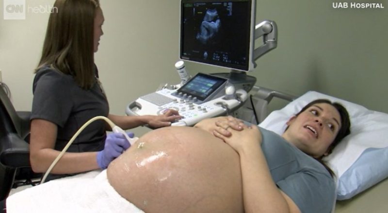Mulher com condição genética rara fica grávida em dois úteros